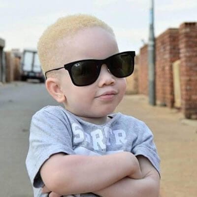Young Albino