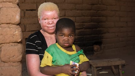 Albino Killings in Malawi