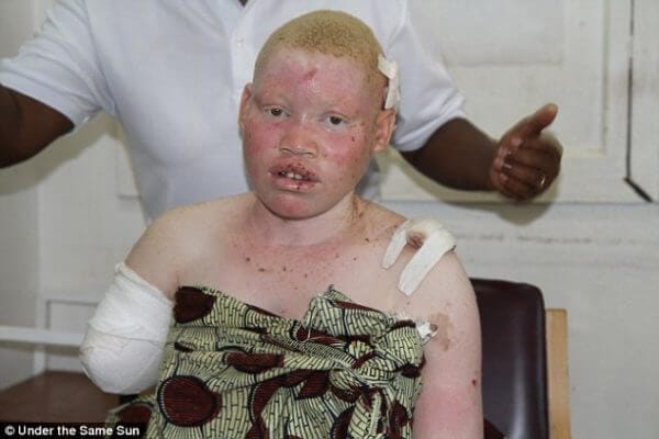 stop killing albinos