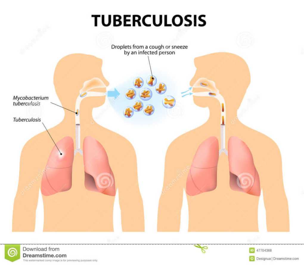 Treatment of multidrug-resistant tuberculosis in Eswatini shows encouraging results