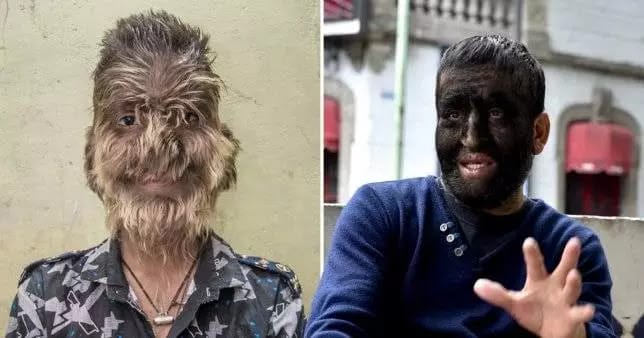 Shocking!Children in Spain develop 'werewolf syndrome' after taking ...