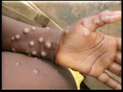 mpox